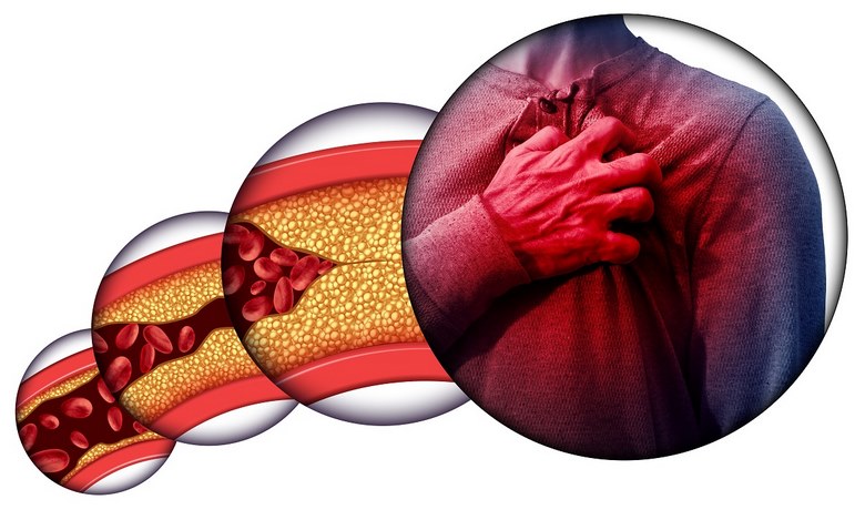 ویژگی های ژنتیکی,ویژگی ژنتیکی,کلسترول بالای خون