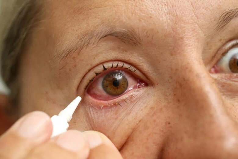 خطرات لنز,خطرات لنز چشم,خطرات لنز گذاشتن