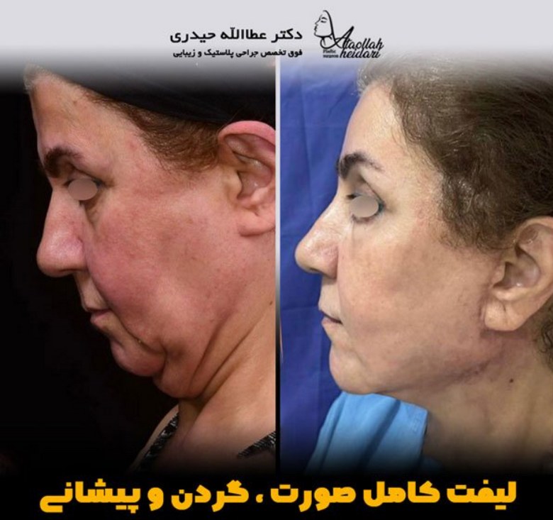 مقایسه انواع روشهای لیفت صورت + بررسی مزایا و معایب عمل جراحی لیفت صورت,مقایسه انواع روشهای لیفت صورت,عمل جراحی لیفت صورت