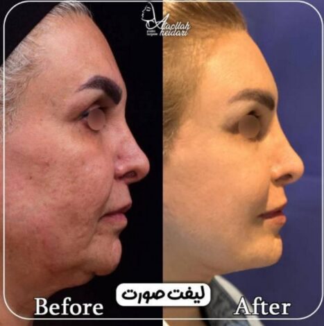 مقایسه انواع روشهای لیفت صورت + بررسی مزایا و معایب عمل جراحی لیفت صورت,مقایسه انواع روشهای لیفت صورت